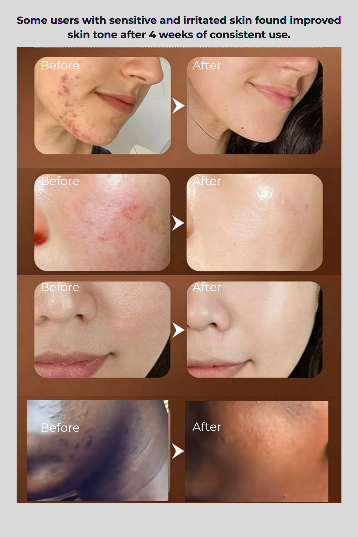 Biolit Led Light Therapy Mask